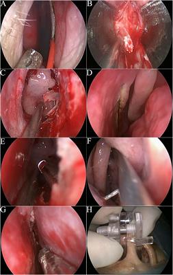 Endoscopic 1½-transseptal approach for pituitary surgery